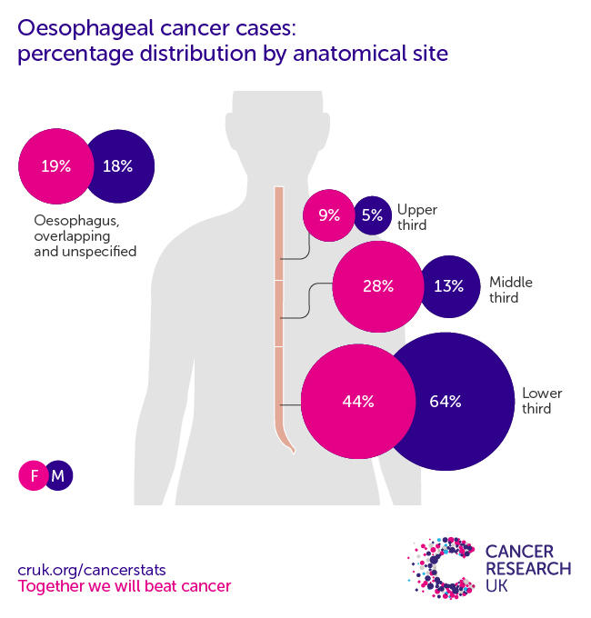 Infographic showing the most common specific location for oesophageal cancers in the UK is the lower third of the oesophagus