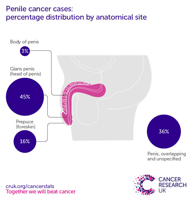 infographic showing the most common specific location for penile cancers in the UK is the glans penis 