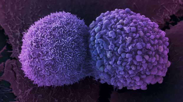 Lung cancer cell Lung cancer cell