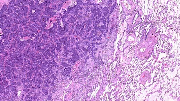 An area of lung tissue showing lung cancer to the left. An area of lung tissue showing lung cancer to the left.