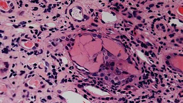 Histopathology of myeloma Histopathology of myeloma