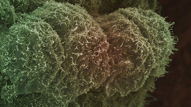 Prostate cancer cell. Electron microscope image of a prostate cancer cell.