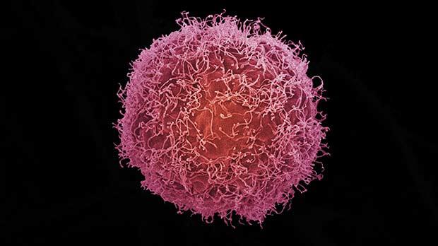 Skin cancer cells under an electron microscope.