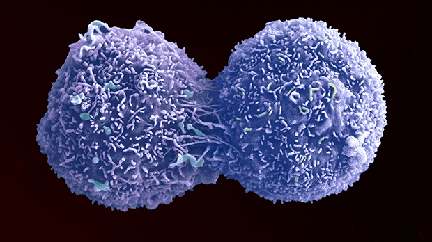 Lung cancer cells under a microscope