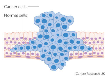 tumour forcing its way through normal tissue