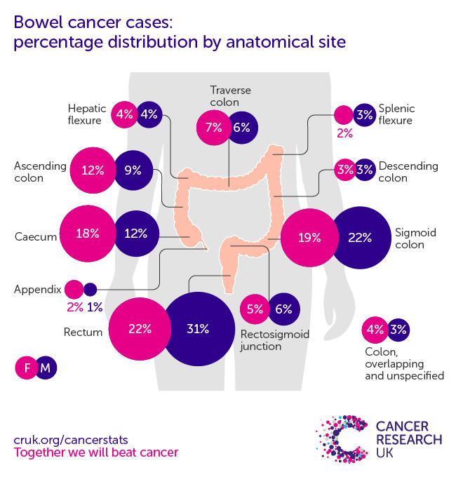 Bowel cancer incidence statistics Cancer Research UK